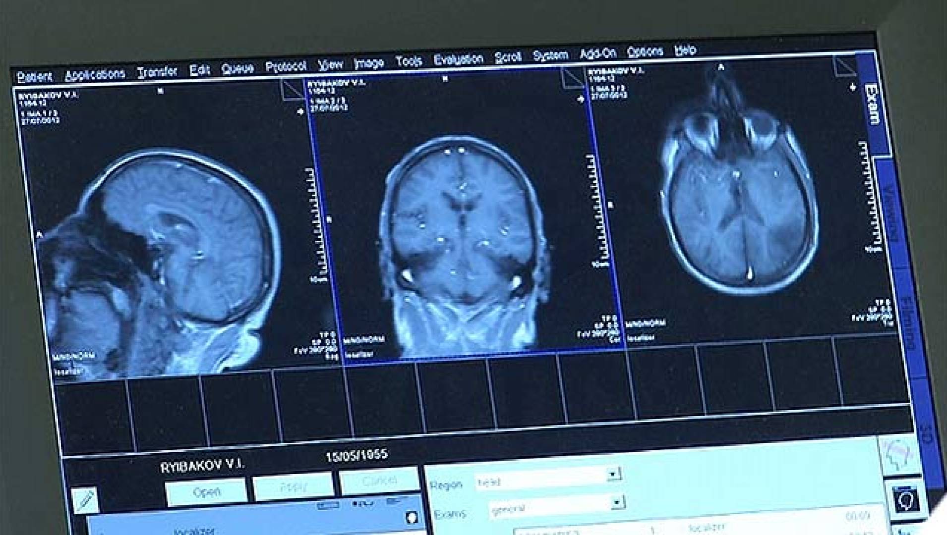 Сужение сосудов головного мозга - Лечение народными средствами